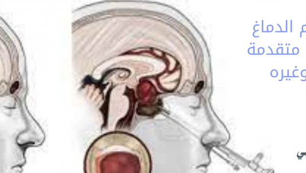عملية استئصال ورم الغدة النخامية  الهند
